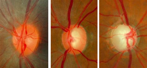 optic nerve different sizes